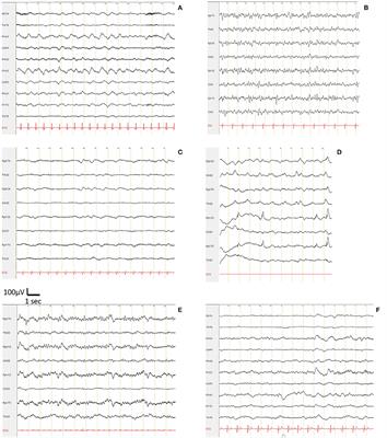 Electroencephalographic Abnormalites in SARS-CoV-2 Patients